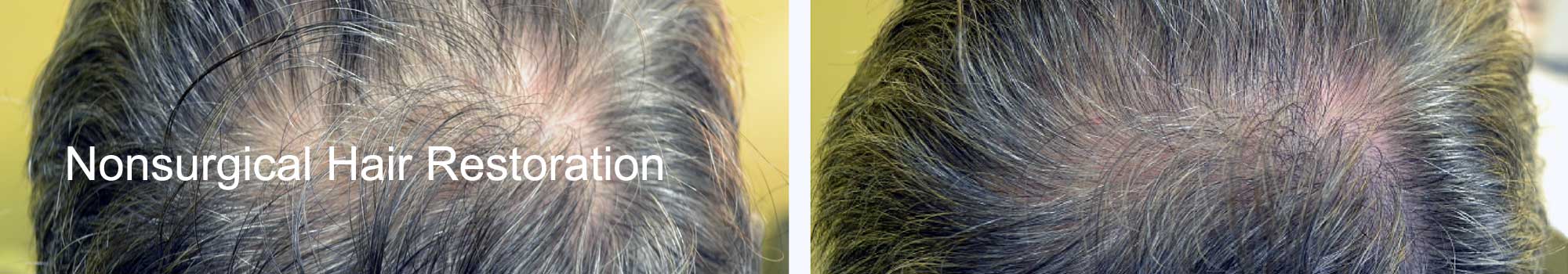 Nonsurgical Hair Restoration